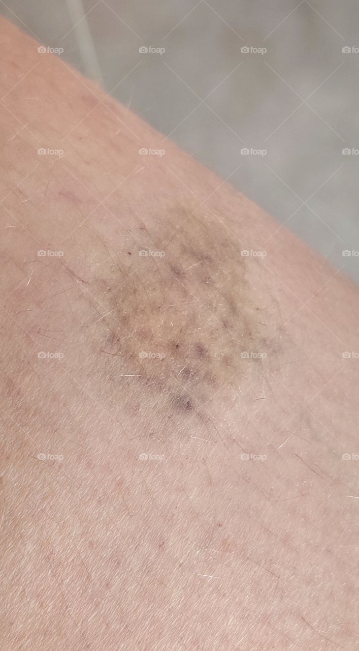 a hematoma on the leg