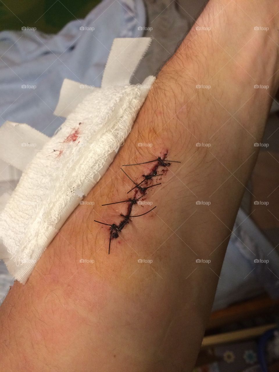 Stitches in arm