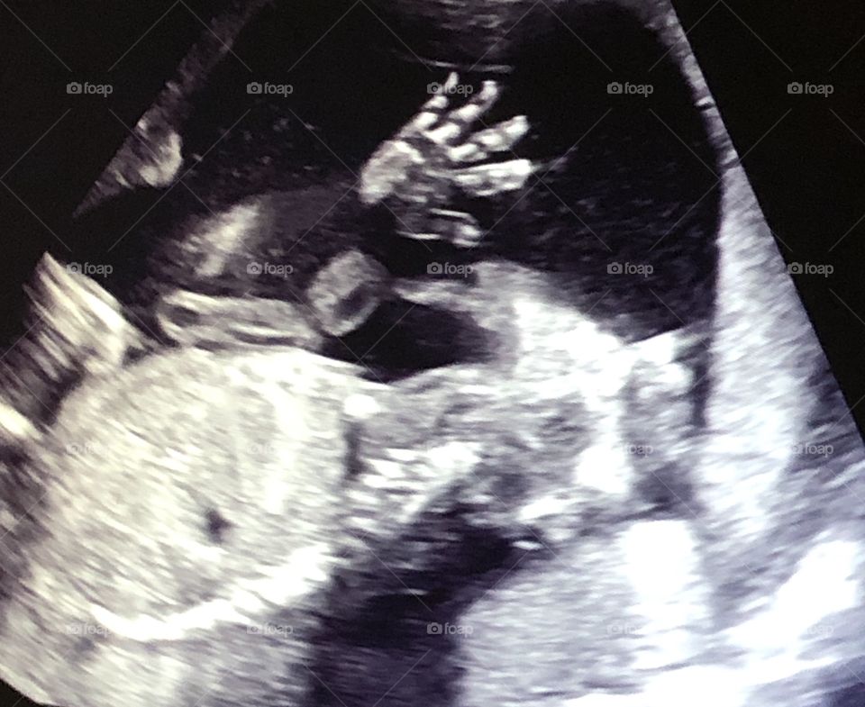 Ultrasound photo baby boy 