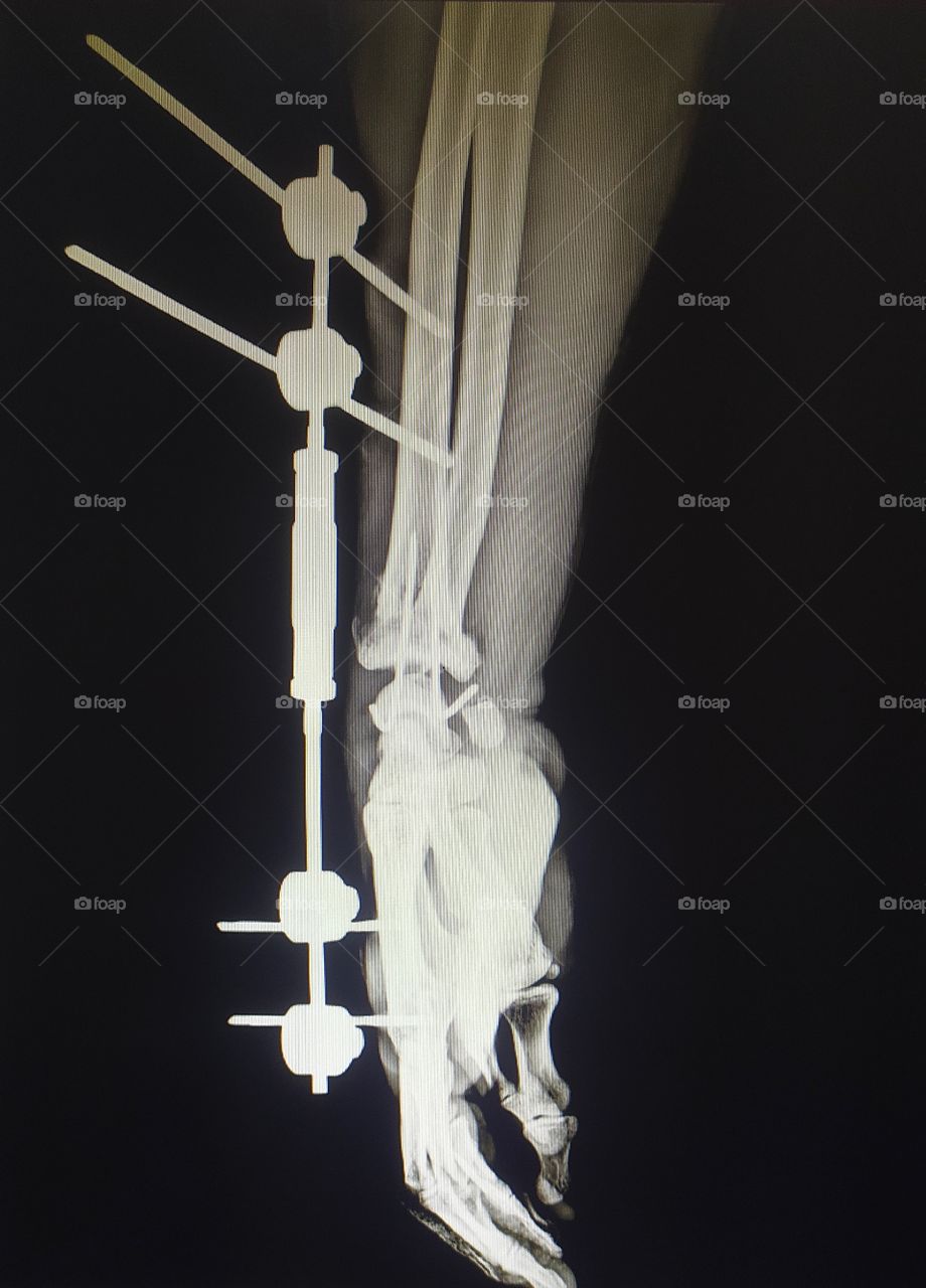Wrist Fixation Procedure post oprative Lateral View Xray