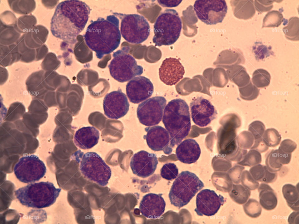 blast blood cells of leukemia