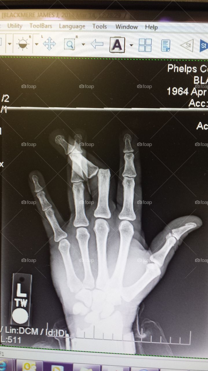 xray of dislocated finger on hand