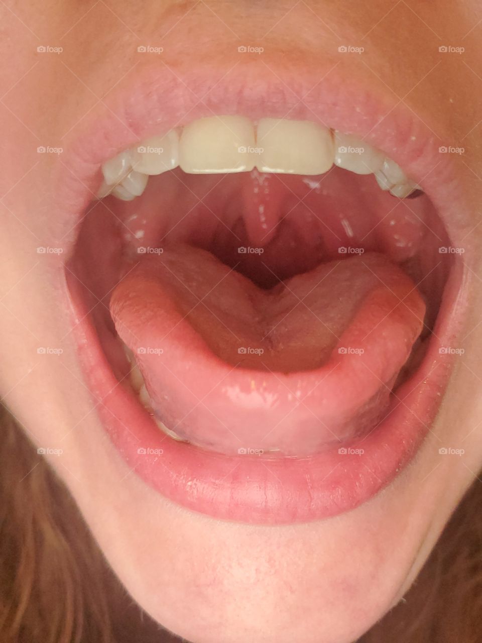Mouth, Teeth, Throat, and Tonsils