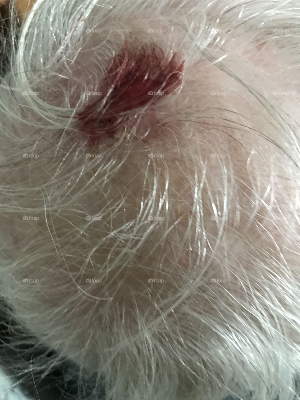 Bloody scalp injury on elderly person