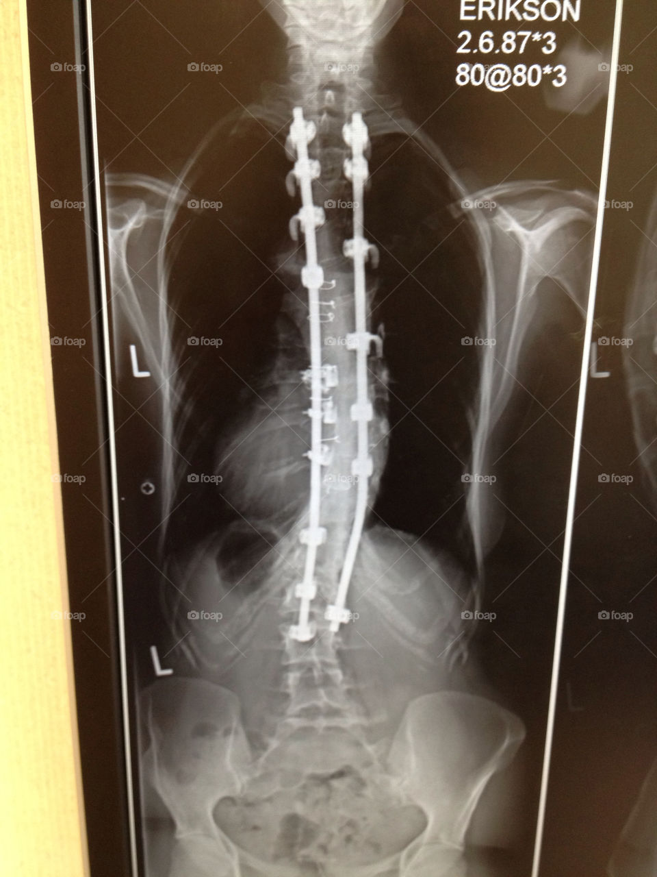 spine bones x-ray back surgery by andyerikson
