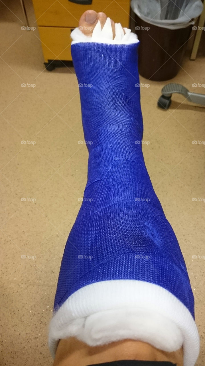 Short leg cast foot surgery - gips fotoperation
