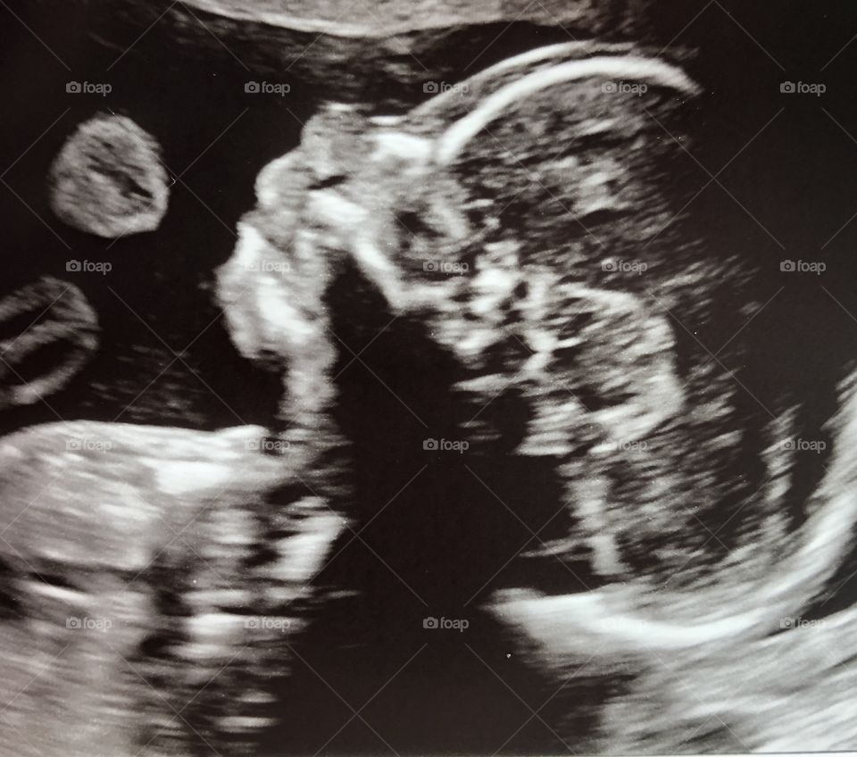 Ultrasound pictures of baby boy 