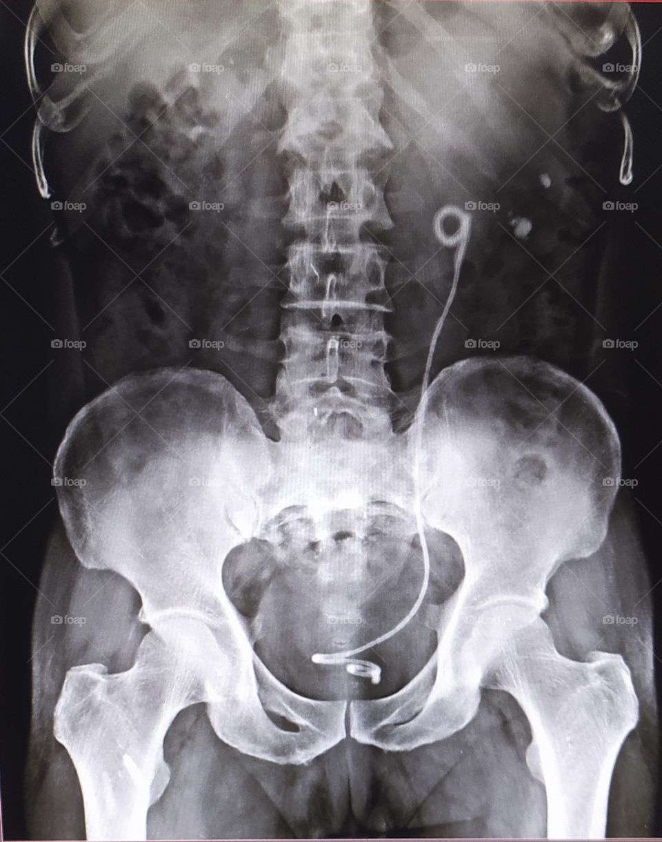 KUB Xray view of human body which shows stent