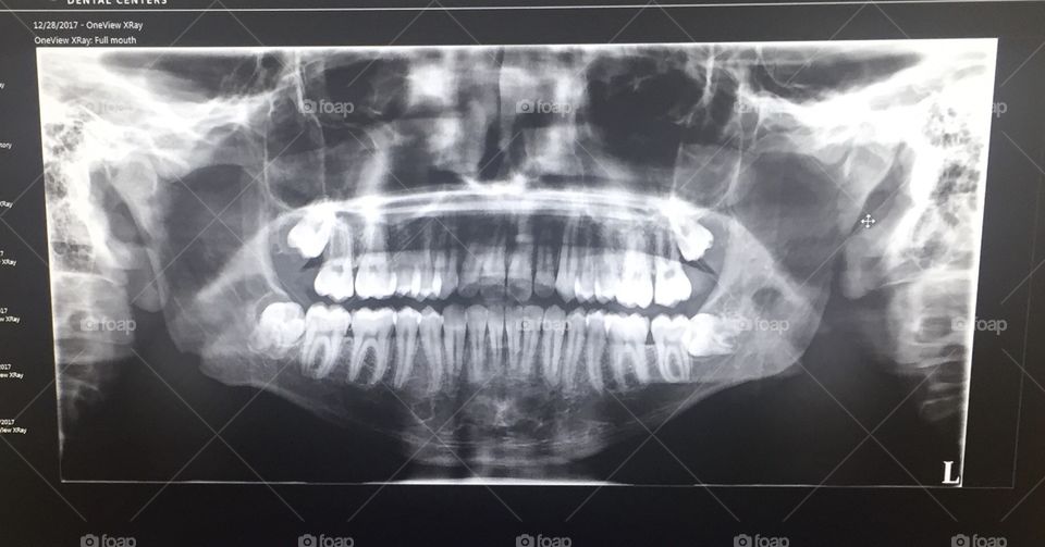 Dental X-ray 