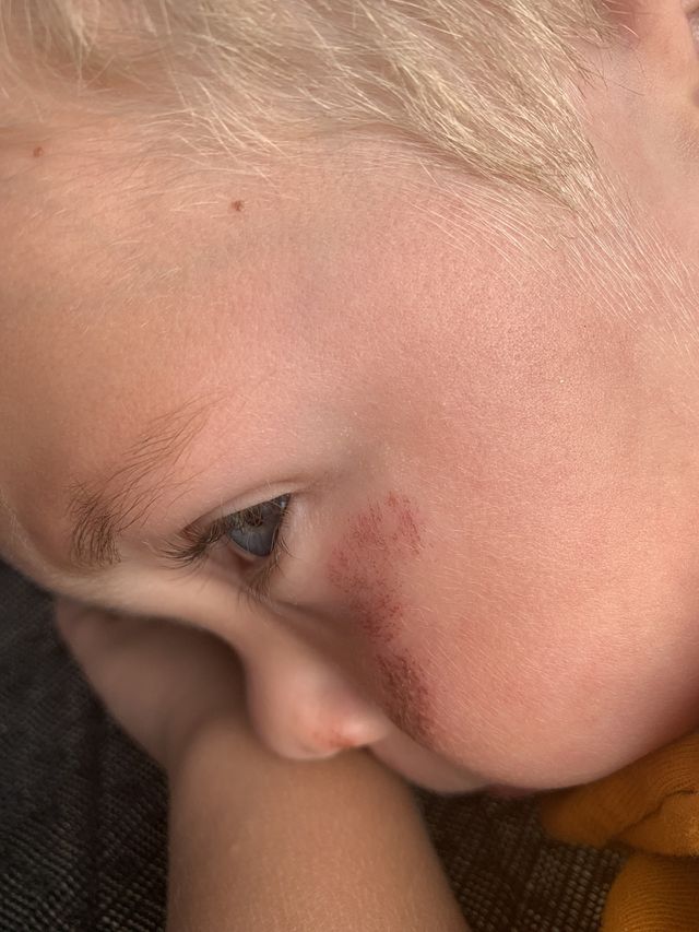 Scrape on the face from falling on sidewalk 