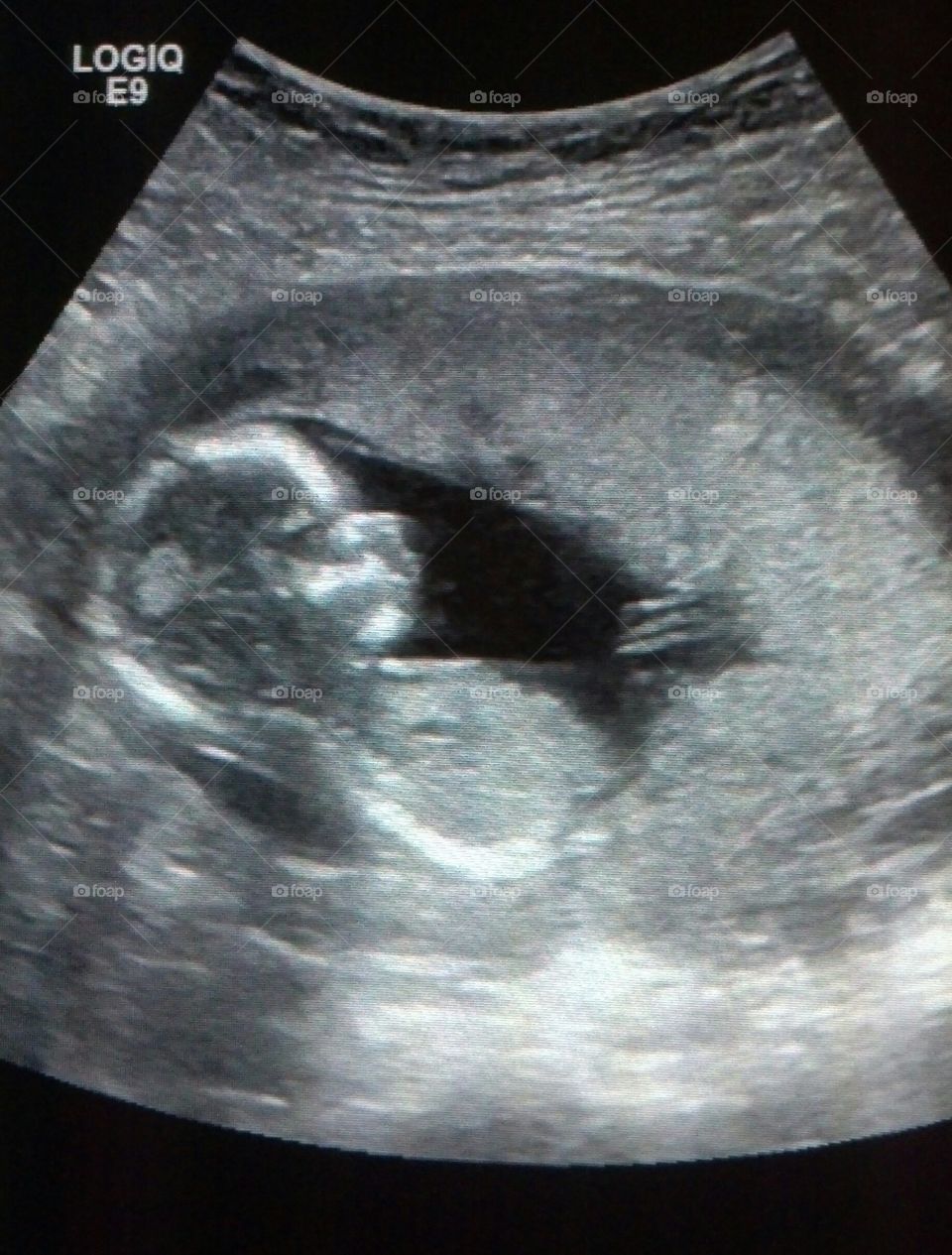 ultrasound of my baby girl