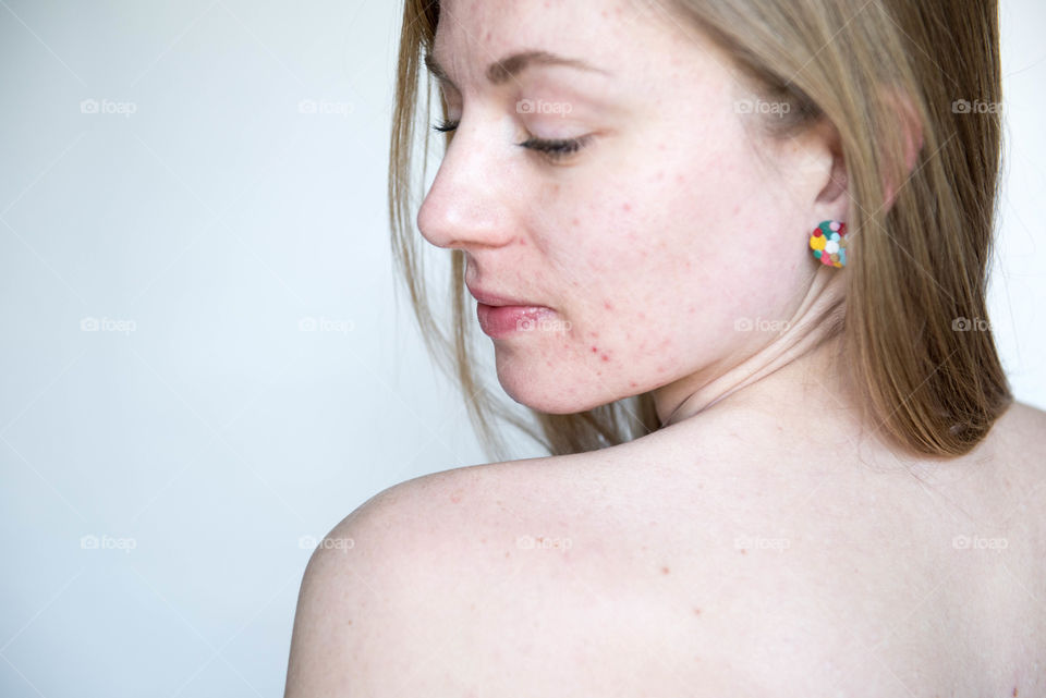 Close-up portrait of a woman with acne prone skin wearing no makeup looking over her shoulder