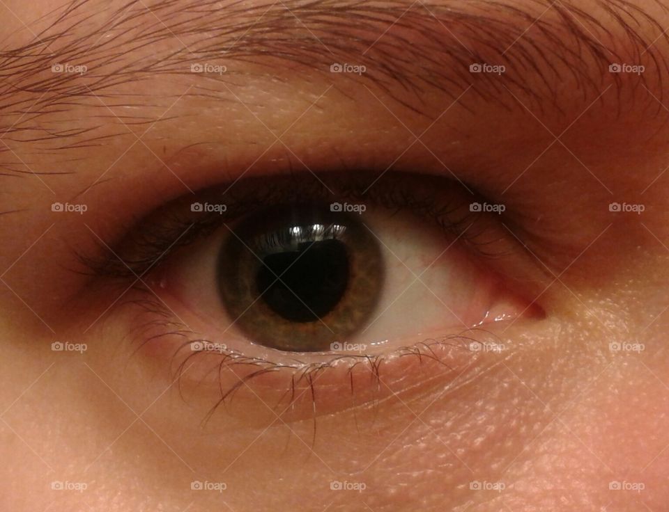 dilation