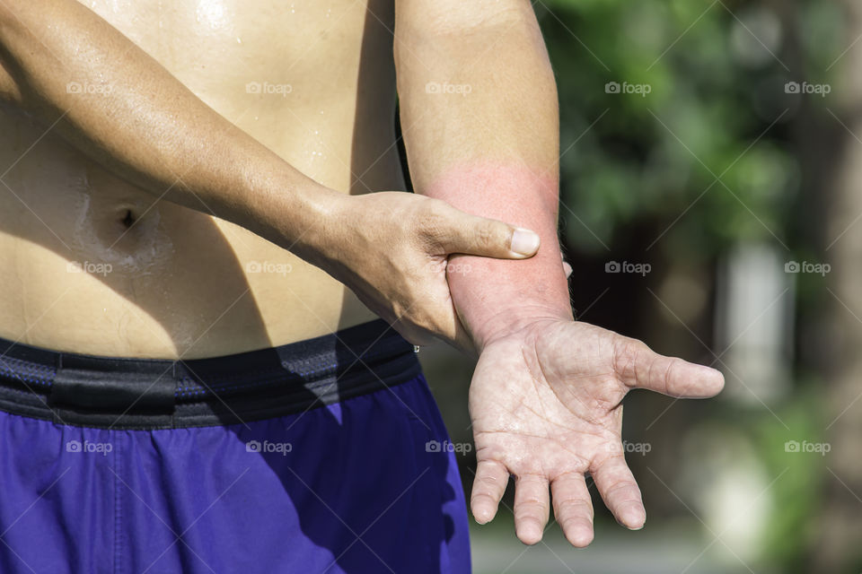 The hand grips the arm that inflammation from a sports injury.