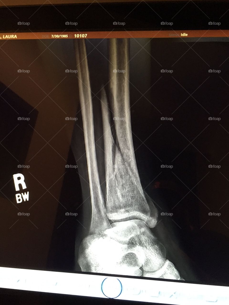 X-ray. Look at my fracture .. It's healing 