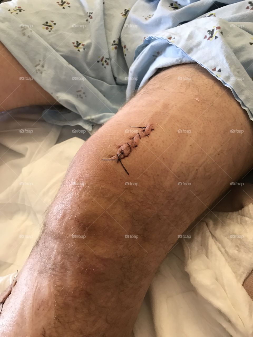 Stitches from rod placement surgery above knee