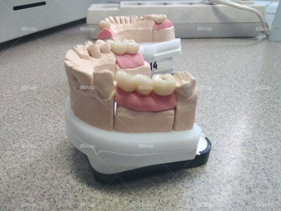 Implantant dental crown