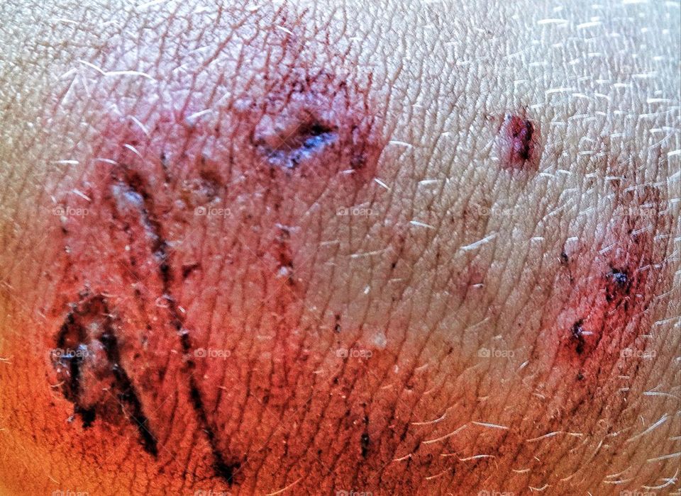 Scab on a knee from bicycle injury