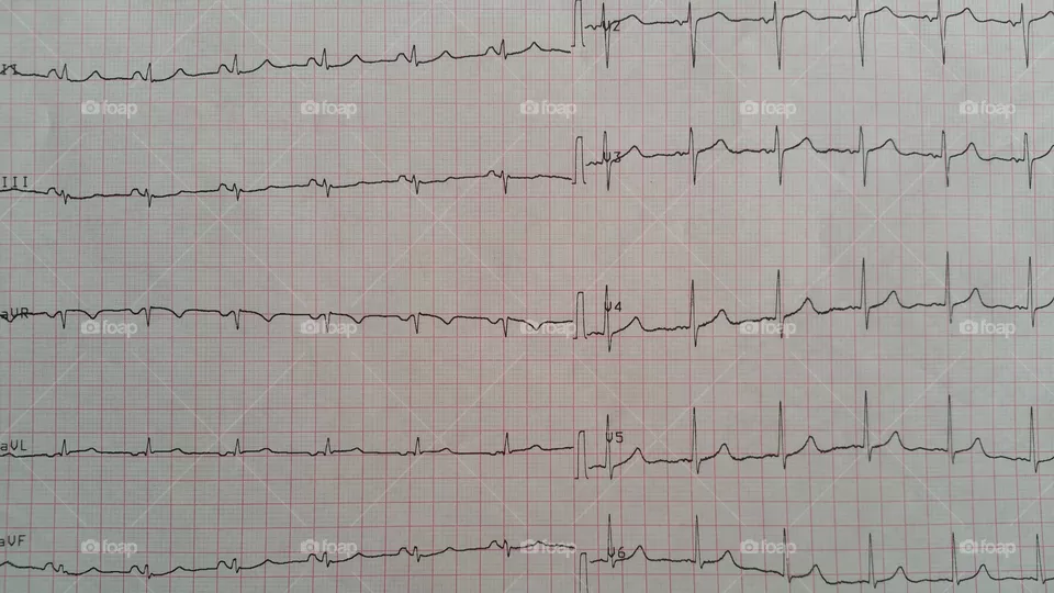 EKG