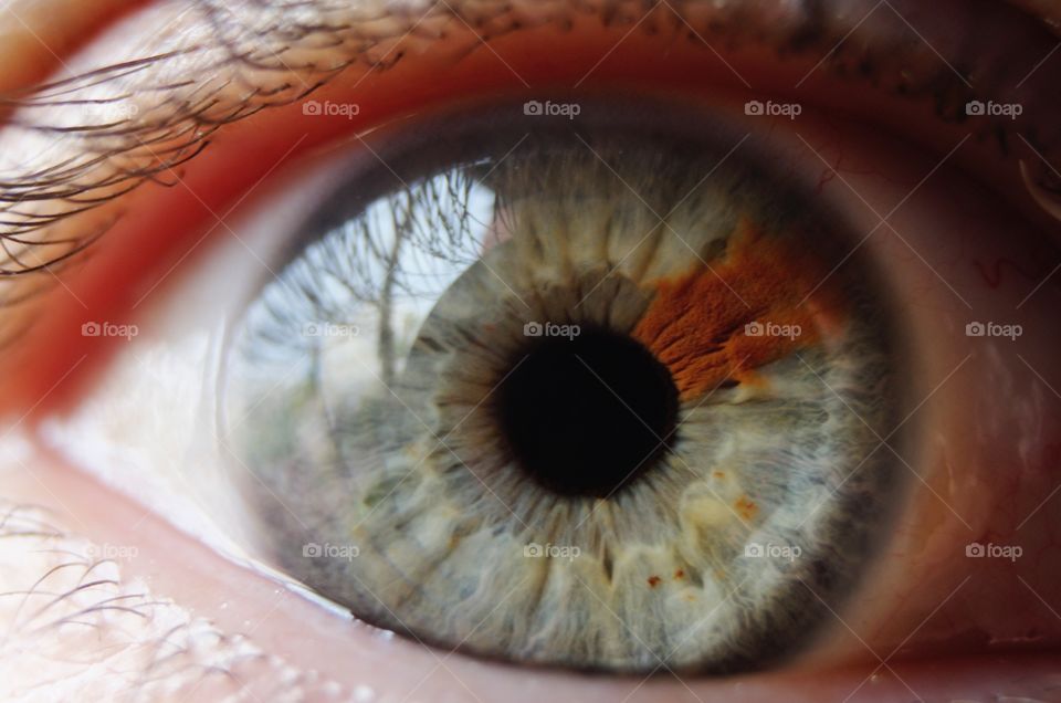 Iris with Sectoral Heterochromia (one section of the iris is a different color from the rest)