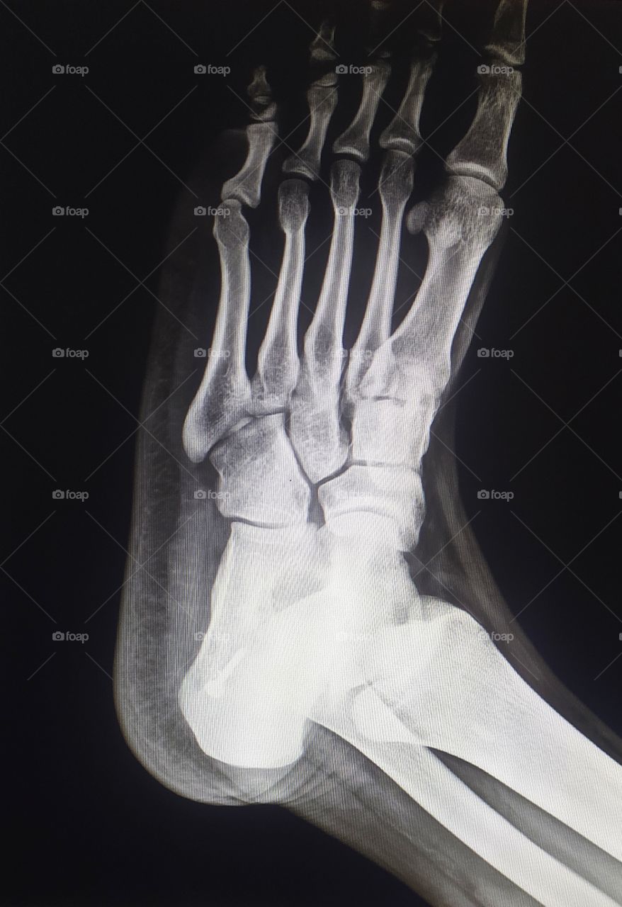 Lower Heel Oblic Xray View shows inserted Iron Nails in lower Heel by nails machin in industrial field accidentally