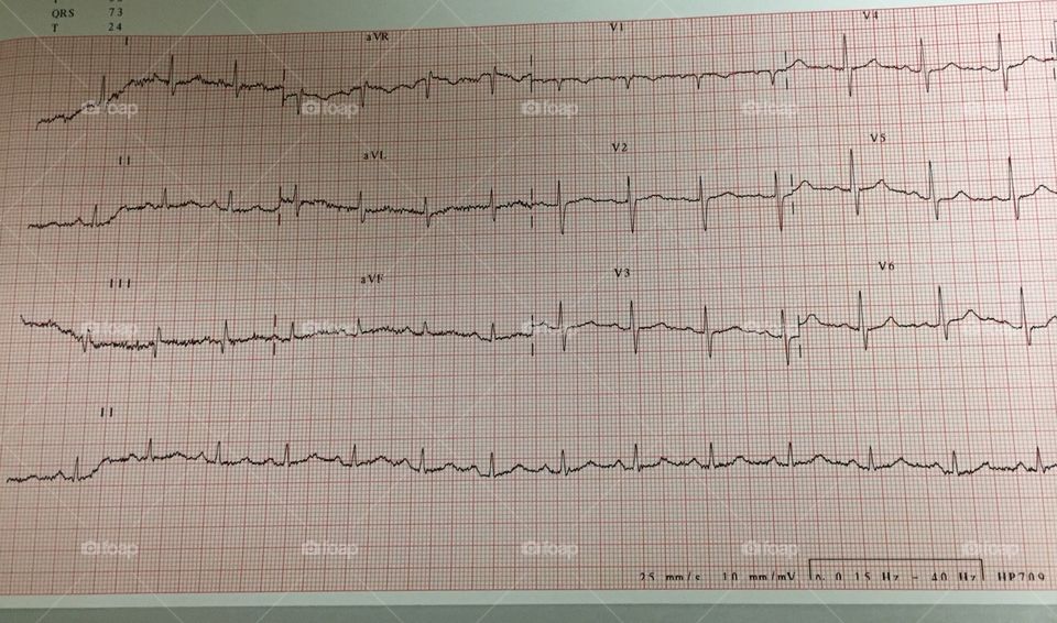 EKG (Electrocardiogram) Taken by Doctor