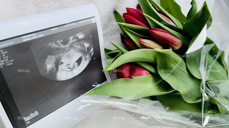 Expecting our first baby 🩵