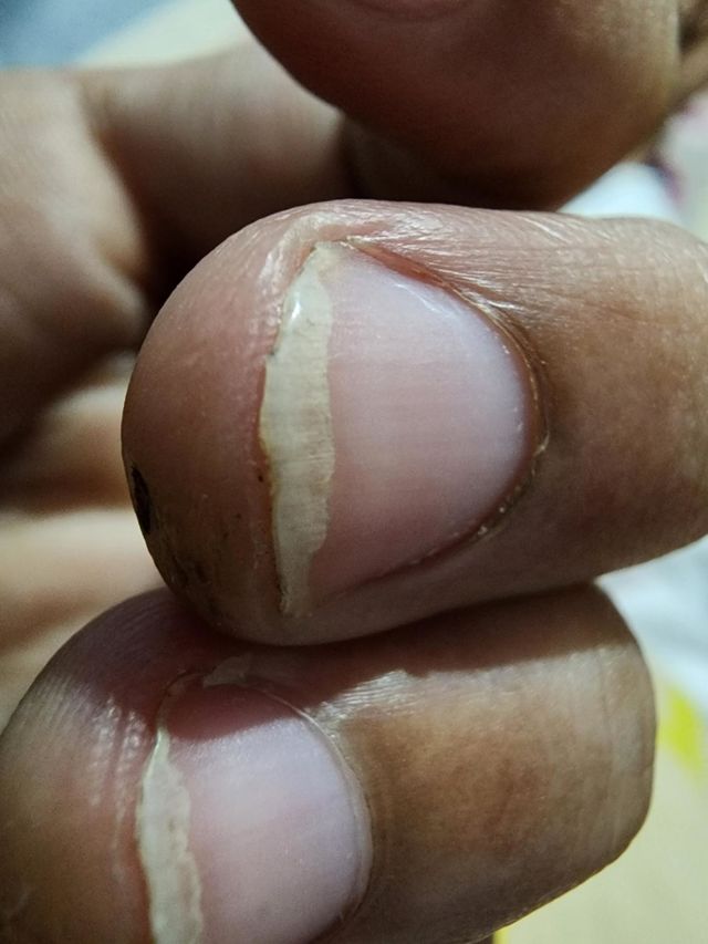 finger nail