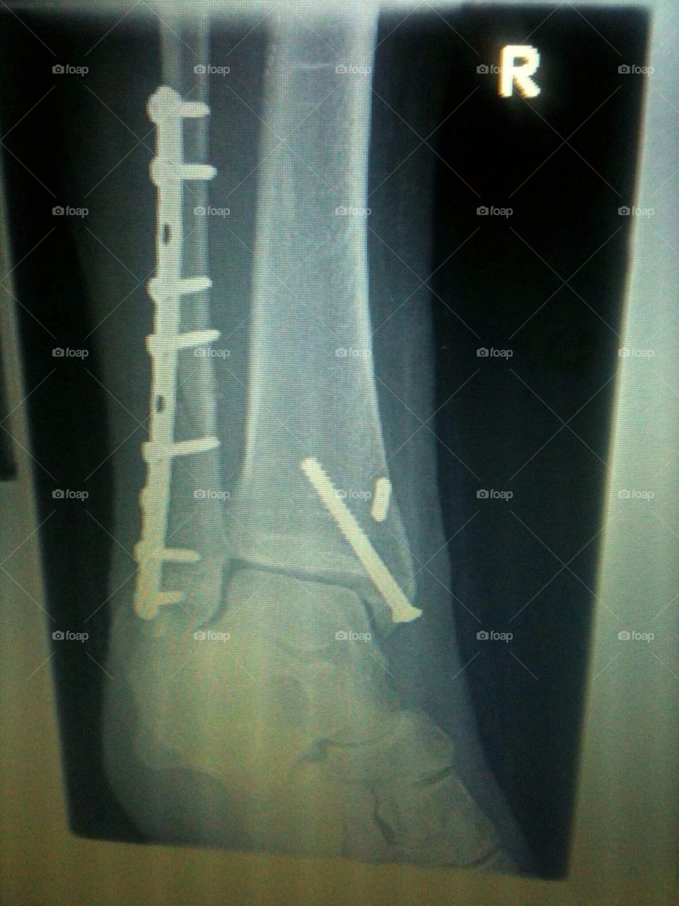 X-ray Broken ankle with metal 