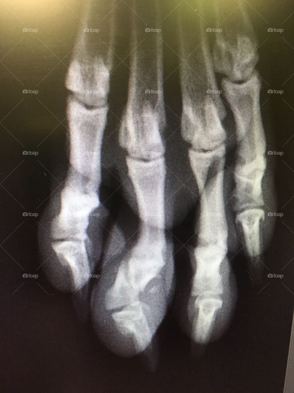 X-ray 
