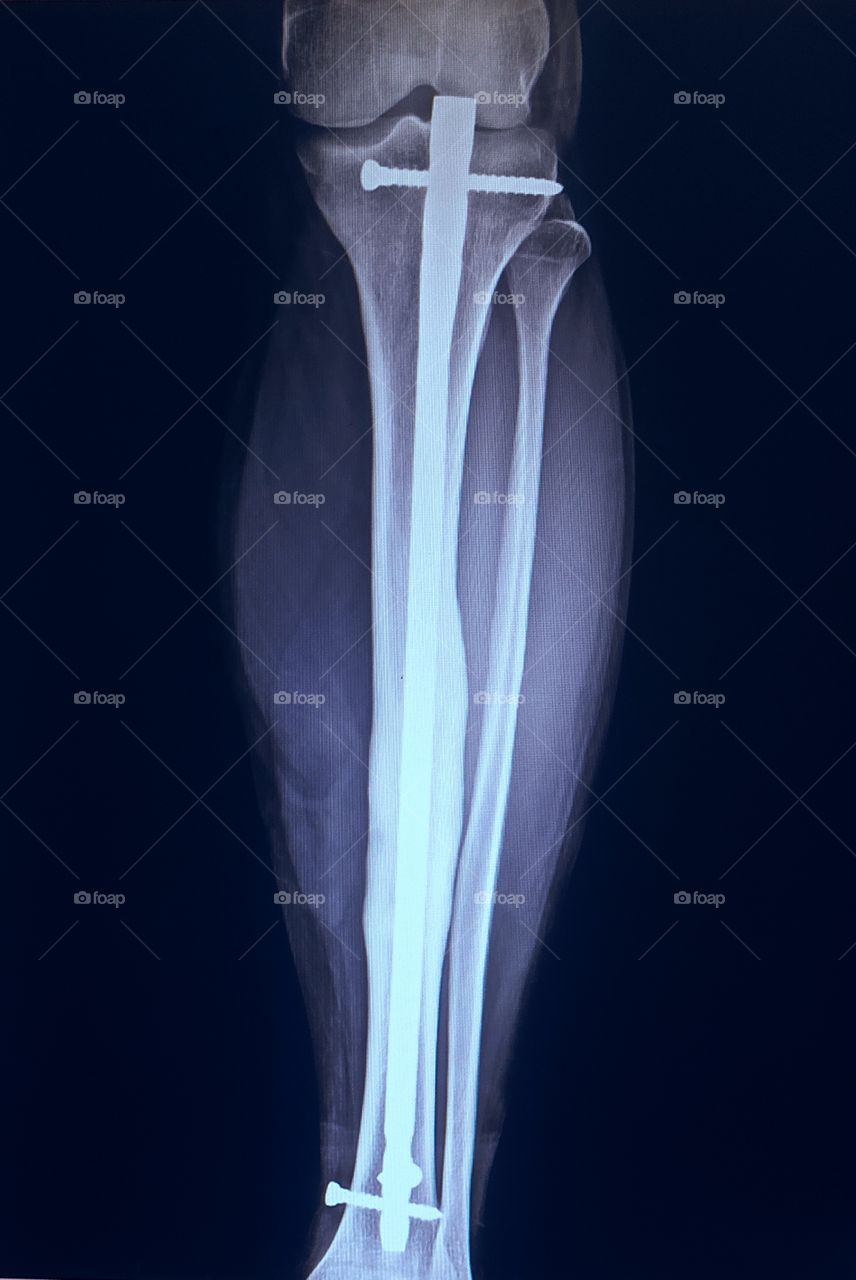 Nail Insertion Post Operative Ap view Xray of Tibia