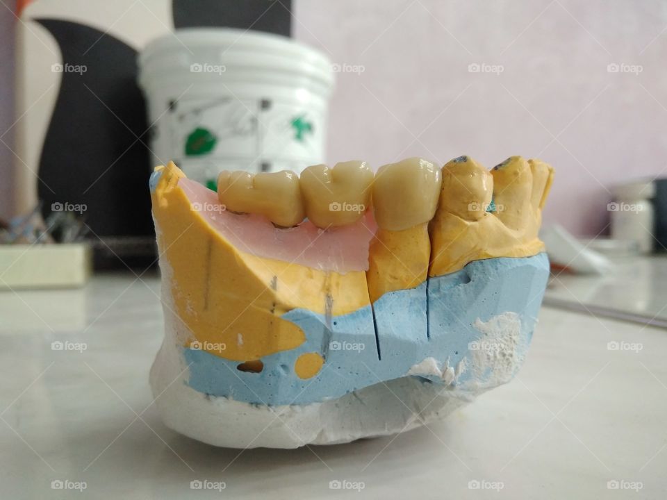 Implantant dental